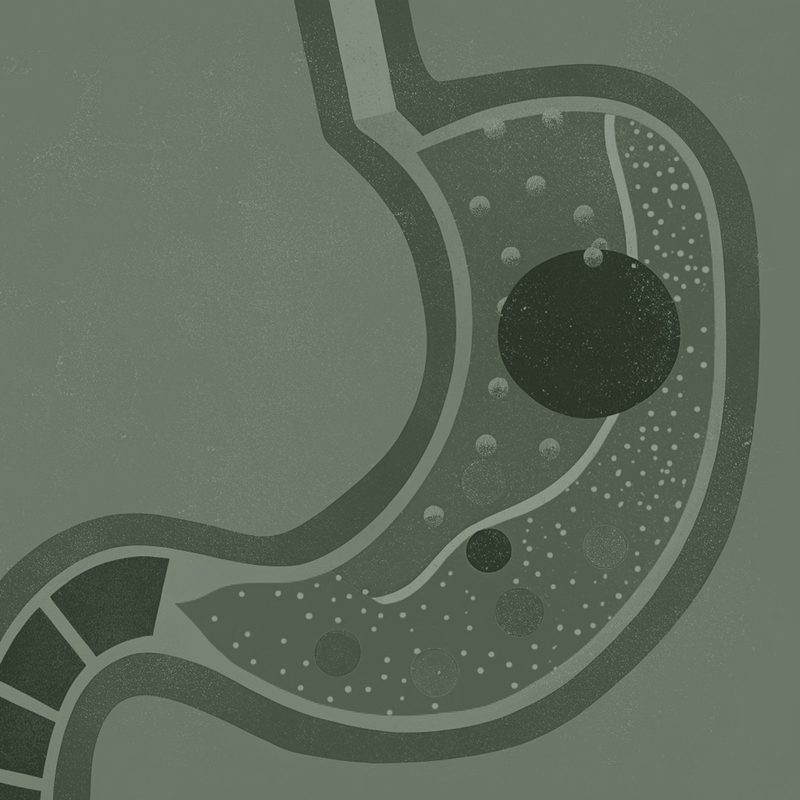 Ilustração de estômago com balão intragástrico